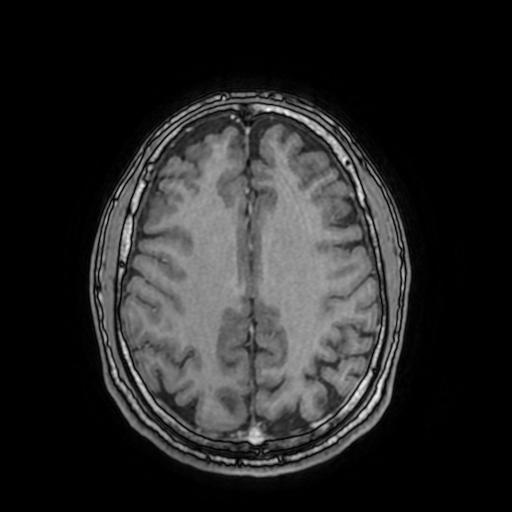 Cerebral venous thrombosis with secondary intracranial hypertension (Radiopaedia 89842-106957 Axial T1 C+ 122).jpg