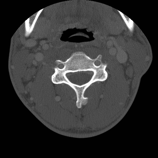 Cervical Pott disease (Radiopaedia 20374-20286 Axial bone window 67).jpg