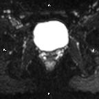 Cervical adenocarcinoma (Radiopaedia 65011-73985 Axial DWI 28).jpg