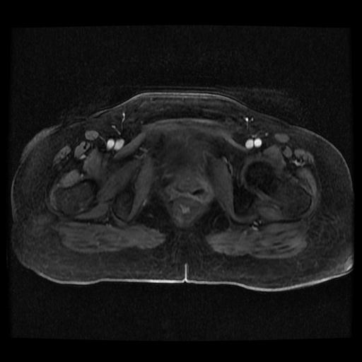 Cervical carcinoma (Radiopaedia 70924-81132 Axial T1 C+ fat sat 32).jpg