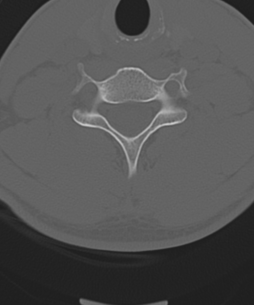 Cervical intercalary bone (Radiopaedia 35211-36748 Axial bone window 45).png