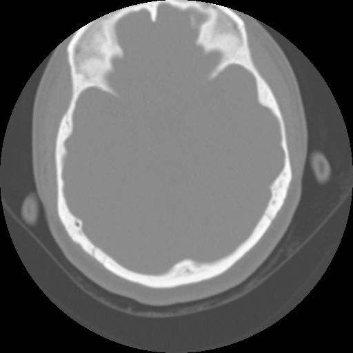 Cervical rib (Radiopaedia 71110-81363 Axial non-contrast 1).jpg