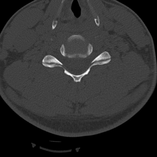 File:Cervical schwannoma (Radiopaedia 57979-64974 Axial bone window 30).png