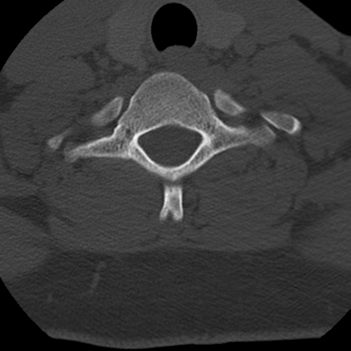 Cervical schwannoma (Radiopaedia 57979-64974 Axial bone window 40).png