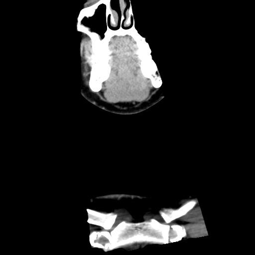 Cervical schwannoma (Radiopaedia 57979-64974 G 9).png