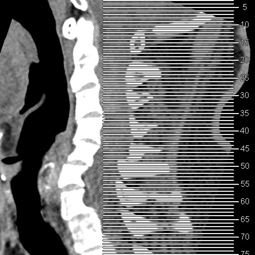 Cervical spinal neurofibroma in a patient with NF1 (Radiopaedia 58344-65464 Axial non-contrast 1).jpg