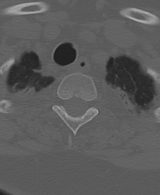 Cervical spine ACDF loosening (Radiopaedia 48998-54071 Axial bone window 57).png