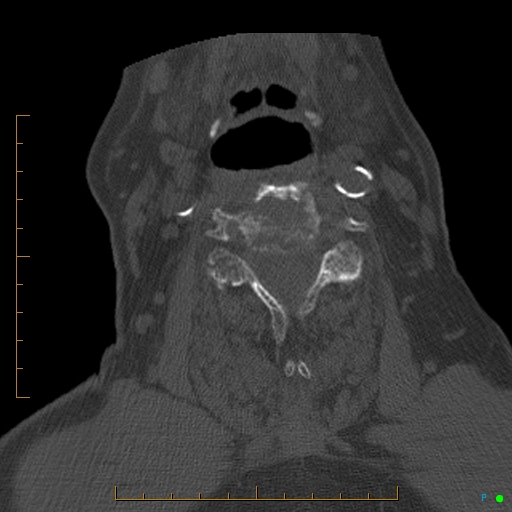 Cervical spine fracture - ankylosing spondylitis (Radiopaedia 76835-88706 Axial bone window 114).jpg
