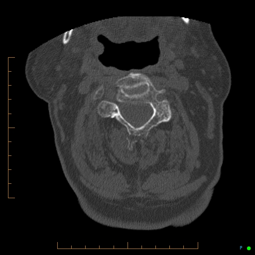 File:Cervical spine fracture - ankylosing spondylitis (Radiopaedia 76835-88706 Axial bone window 77).jpg