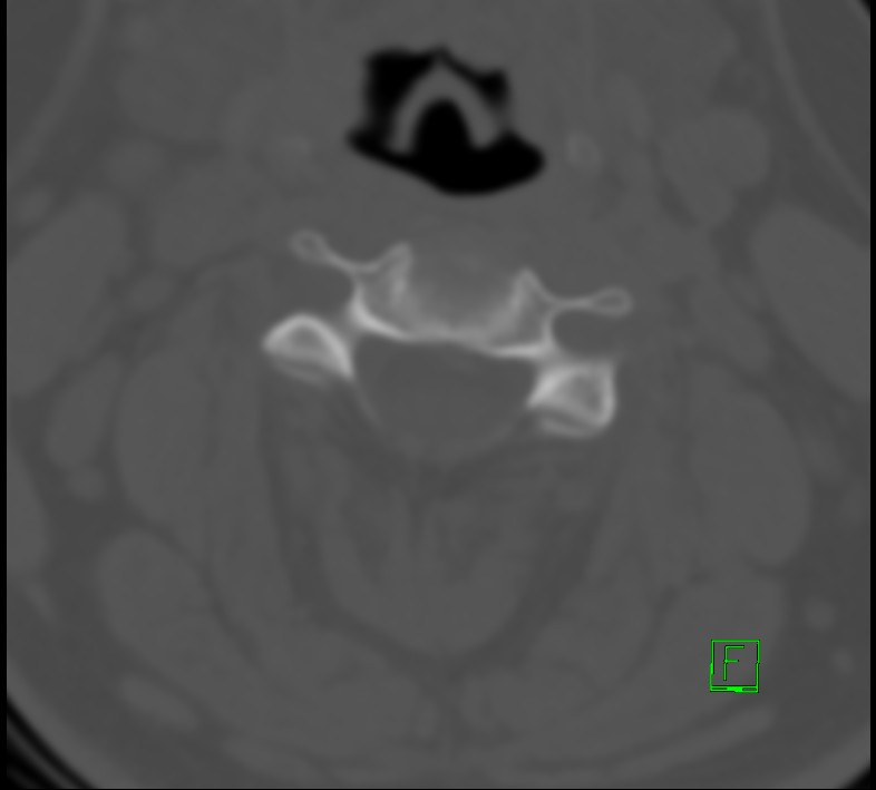 Cervical spine fracture - hyperflexion injury (Radiopaedia 66184-75364 Axial bone window 13).jpg