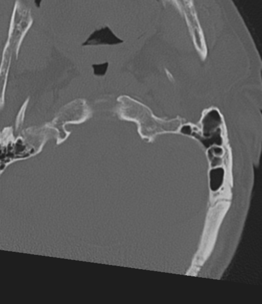 Cervical spine fracture in the setting of ankylosis (Radiopaedia 37038-38715 Axial bone window 8).png