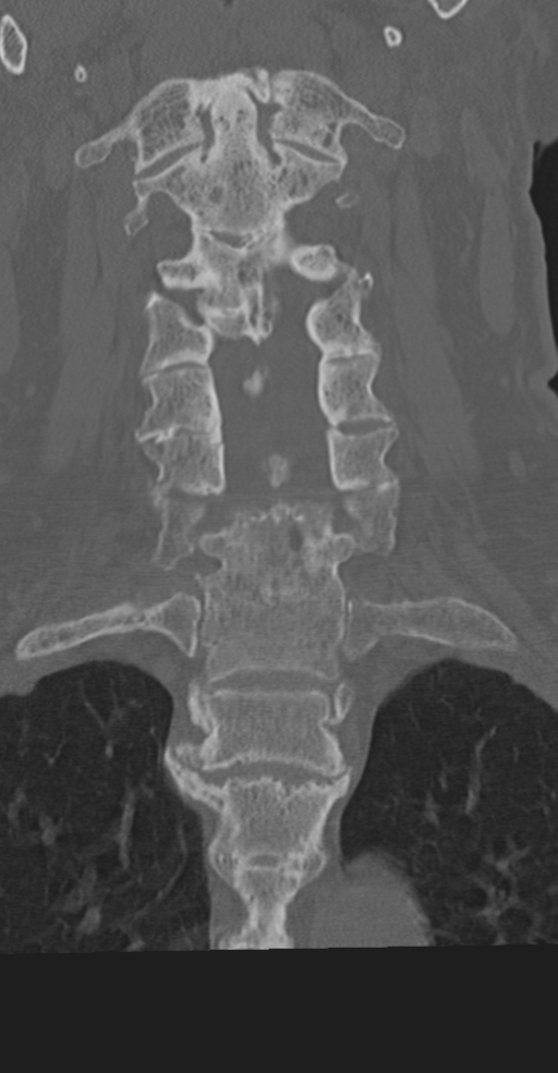 Cervical spine fracture in the setting of ankylosis (Radiopaedia 37038-38715 Coronal bone window 33).png