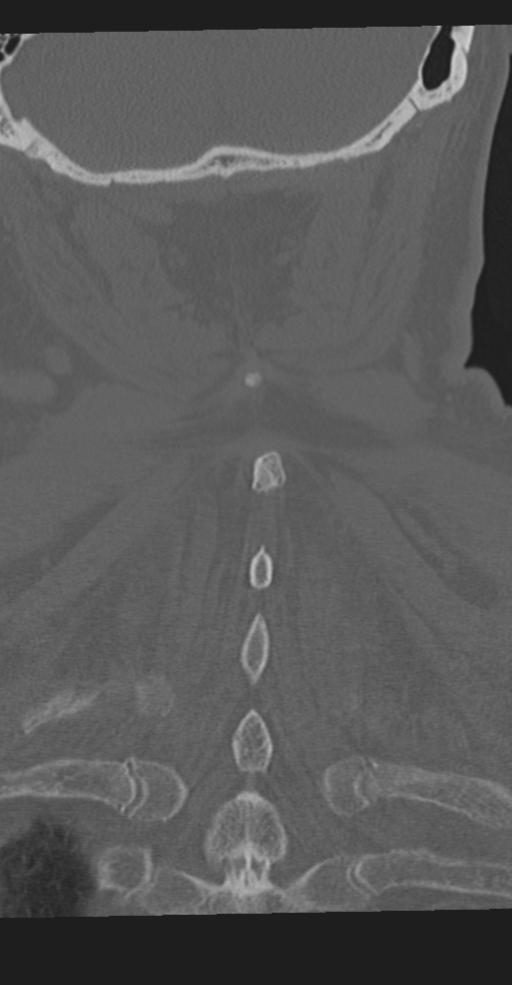 Cervical spine fracture in the setting of ankylosis (Radiopaedia 37038-38715 Coronal bone window 60).png