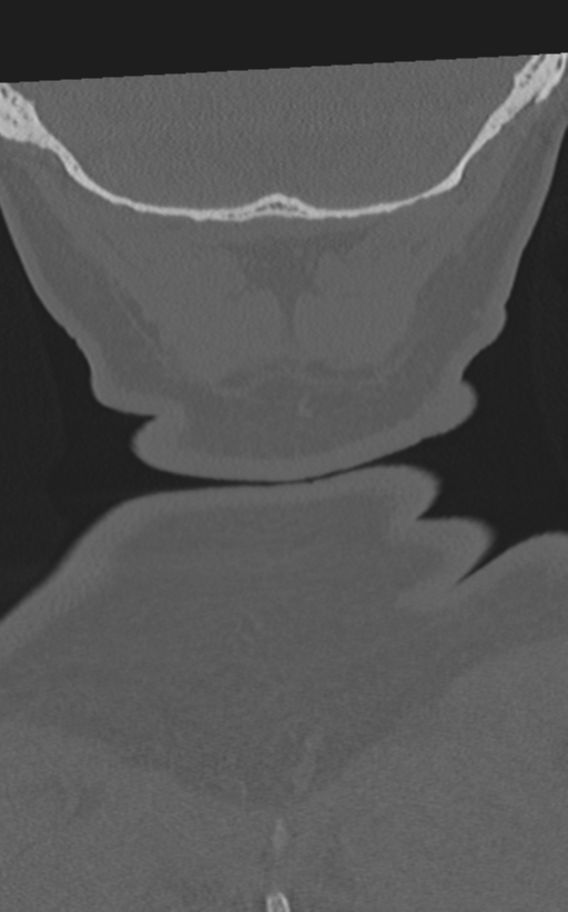 Cervical spine fractures with vertebral artery dissection (Radiopaedia 53296-59268 Coronal bone window 72).png