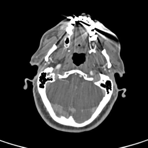 Cervical spine fractures with vertebral artery dissection (Radiopaedia 53296-59269 A 79).png