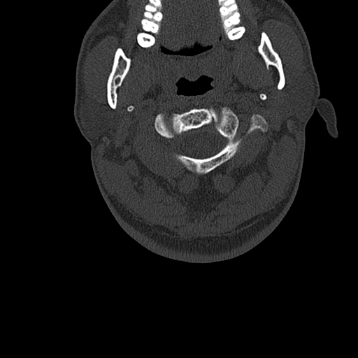 File:Cervical spine trauma with tear drop fracture and perched facet joint (Radiopaedia 53989-60127 Axial bone window 24).jpg