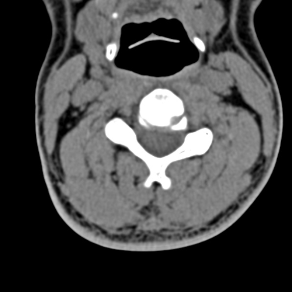 Cervical spondylodiscitis (Radiopaedia 28057-29489 Axial non-contrast 36).jpg