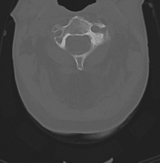 Cervical spondylolysis (Radiopaedia 49616-54811 Axial bone window 17).png