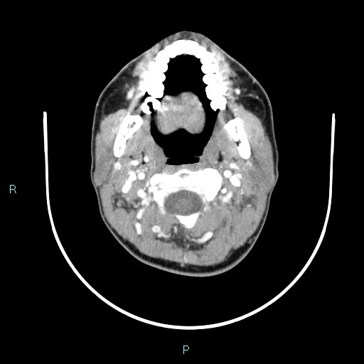 Cervical thymic cyst (Radiopaedia 88632-105335 B 87).jpg