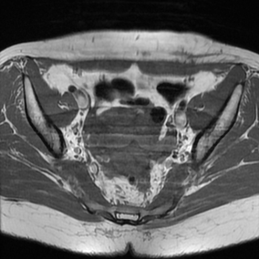 File:Cesarian section scar endometriosis (Radiopaedia 66520-75799 Axial T1 9).jpg
