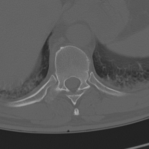 Chance fracture (Radiopaedia 33854-35020 Axial bone window 68).png
