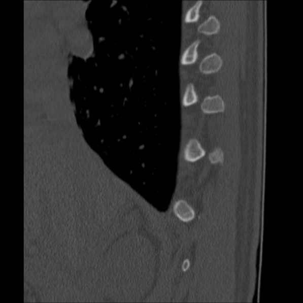 Chance fracture (Radiopaedia 36521-38081 Sagittal bone window 6).jpg