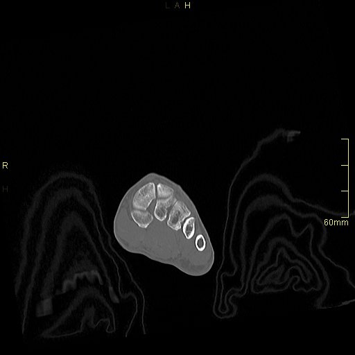 Chaput tubercle fracture (Radiopaedia 80319-93956 Coronal non-contrast 8).jpg