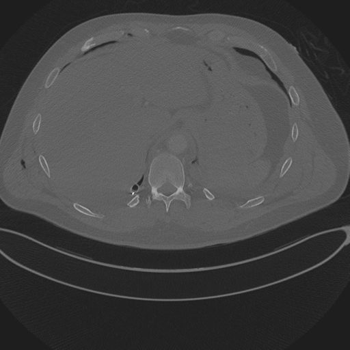 Chest multitrauma - aortic injury (Radiopaedia 34708-36147 Axial bone window 261).png