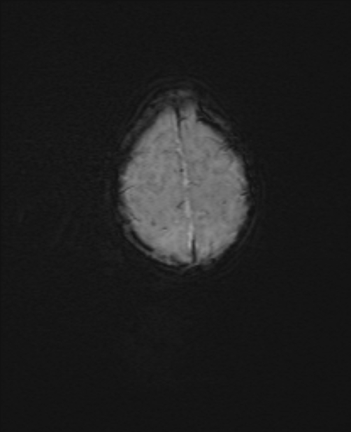 Chiari III malformation with occipital encephalocele (Radiopaedia 79446-92559 Axial SWI 54).jpg