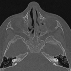 Choanal atresia (Radiopaedia 88525-105975 Axial bone window 50).jpg