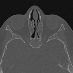 Choanal atresia (Radiopaedia 88525-105975 Axial bone window 69).jpg