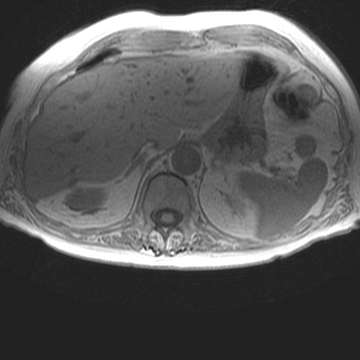 File:Cholangiocarcinoma - mass-forming pattern (Radiopaedia 16017-15677 T1 in-phase 9).jpg