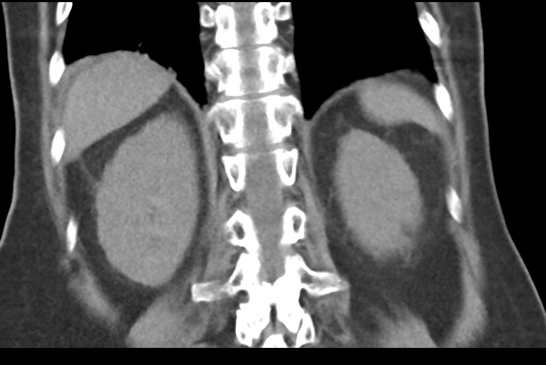 File:Cholecystitis - obstructive choledocholitiasis (CT intravenous cholangiography) (Radiopaedia 43966-47479 Coronal 30).png