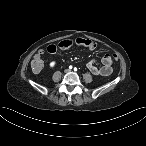 Cholecystoduodenal fistula due to calculous cholecystitis with gallstone migration (Radiopaedia 86875-103077 A 44).jpg