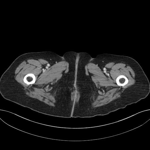 Cholecystoduodenal fistula due to calculous cholecystitis with gallstone migration (Radiopaedia 86875-103077 D 91).jpg