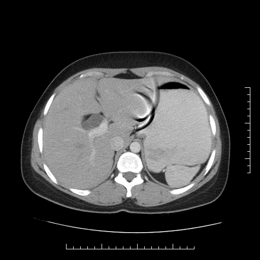 File:Choledochal cyst with chronic calcific pancreatitis (Radiopaedia 18245-18061 A 5).png