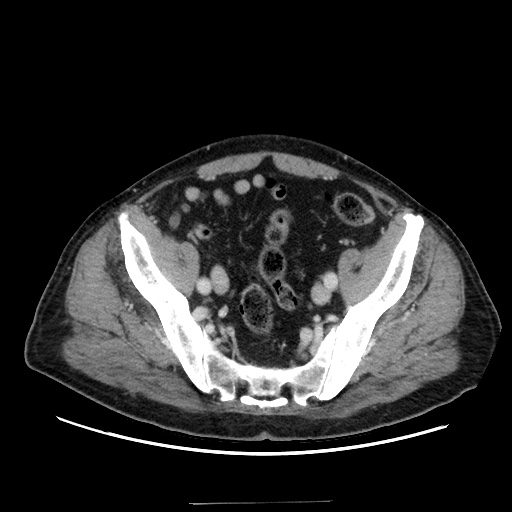 Choledocholiathiasis with normal caliber common bile duct (Radiopaedia 75368-86632 A 156).jpg
