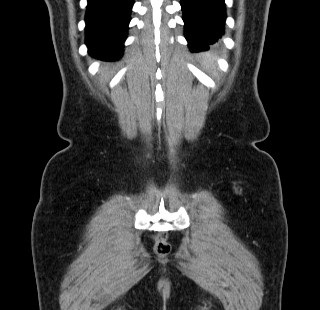 Choledocholithiasis on CT and MRI (Radiopaedia 24825-25087 C 48).jpg
