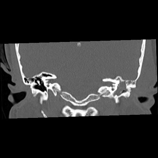 Cholesteatoma (Radiopaedia 84960-100474 Coronal bone window 32).jpg
