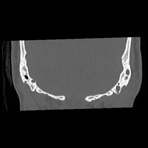 Cholesteatoma (Radiopaedia 84960-100474 Coronal bone window 64).jpg
