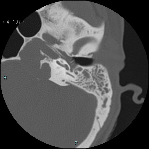 File:Cholesterol granuloma of the petrous apex (Radiopaedia 64358-73141 Axial bone window 52).jpg