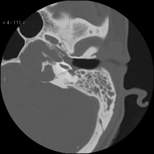 File:Cholesterol granuloma of the petrous apex (Radiopaedia 64358-73141 Axial bone window 53).jpg