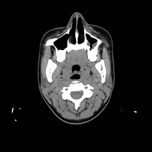 File:Chondroblastic osteosarcoma (Radiopaedia 67363-76741 Axial non-contrast 7).jpg
