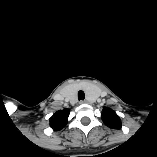 File:Chondroblastic osteosarcoma (Radiopaedia 67363-76741 Axial with contrast 4).jpg