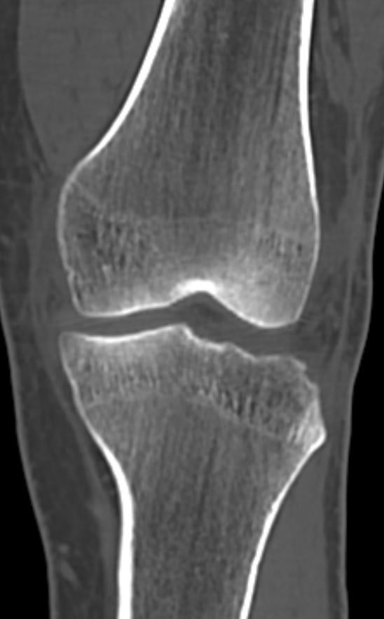 Chondrocalcinosis (Radiopaedia 82862-97173 Coronal bone window 33).jpg