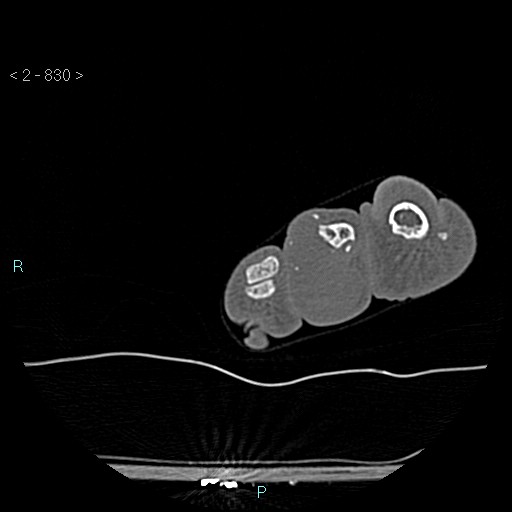 Chondrosarcoma - phalanx (Radiopaedia 69047-78812 Axial bone window 84).jpg