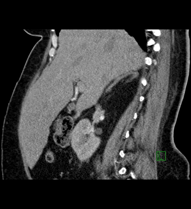 Chromophobe renal cell carcinoma (Radiopaedia 84239-99519 D 74).jpg