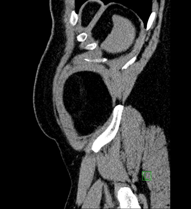 Chromophobe renal cell carcinoma (Radiopaedia 84286-99573 C 9).jpg