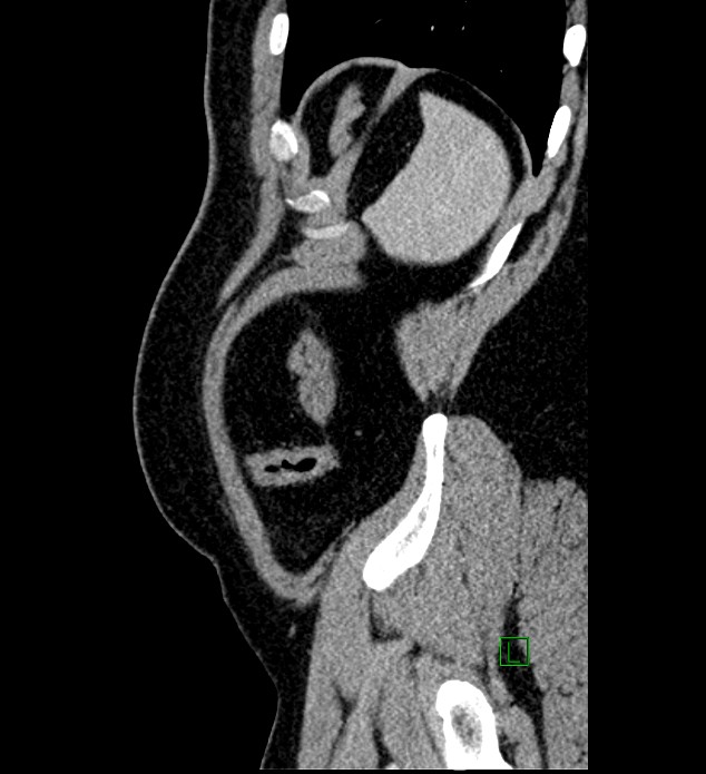 Chromophobe renal cell carcinoma (Radiopaedia 84286-99573 I 17).jpg