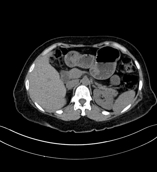 Chromophobe renal cell carcinoma (Radiopaedia 84290-99582 Axial non-contrast 44).jpg